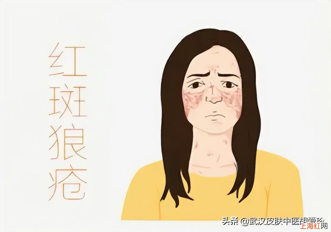 脸颊两边老是红红的怎么回事 为什么脸部总是泛红怎么治