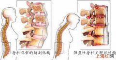 强直性脊柱炎是什么病啊怎么治疗 强直性脊柱炎最好的治疗办法