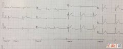 心电图怎么看