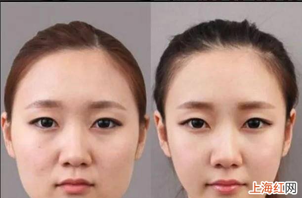 如何快速瘦脸