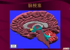 55岁有脑梗塞还能活多久